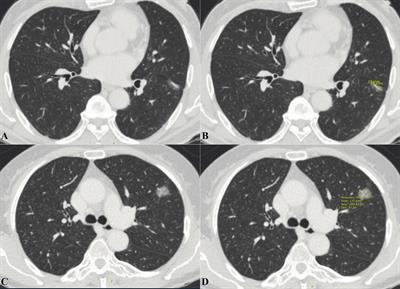 A nomogram combining thoracic CT and tumor markers to predict the malignant grade of pulmonary nodules ≤3 cm in diameter